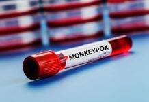 The first case of monkeypox found in Delhi, patient isolate